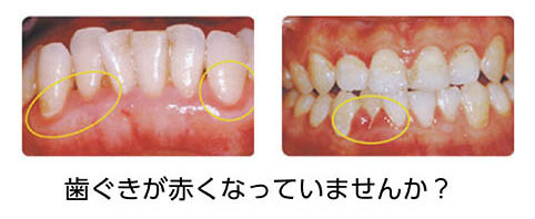 歯石について